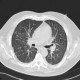 Pneumocystis pneumonia: CT - Computed tomography